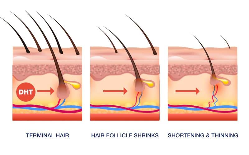 Understanding Male Pattern Hair Loss